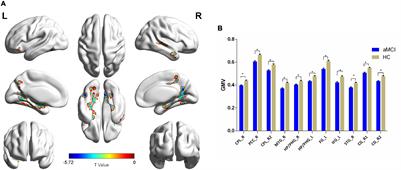 Concurrent Structural and Functional Patterns in Patients With Amnestic Mild Cognitive Impairment